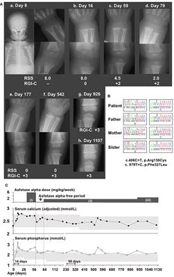 Case Report: Efficacy of Reduced Doses of Asfotase Alfa Replacement Therapy in an Infant With Hypophosphatasia Who Lacked Severe Clinical Symptoms